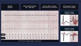 Atrioventricular Nodal Reentry Tachycardia AVNRT ECG [upl. by Yraccaz]