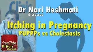 Itching in Pregnancy PUPPPs vs Cholestasis of Pregnancy Discussed by Dr Nari Heshmati [upl. by Nahor]