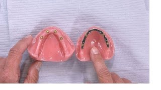 Case of the Week Creating a Crown Underneath a Partial Denture [upl. by Aserehs77]