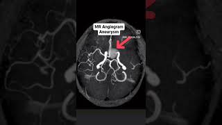 Aneurysm  MRI Brain Angiogram mri shorts youtubeshorts [upl. by Alrac]