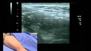 Femoral Nerve Block ultrasound guided [upl. by Hogen]