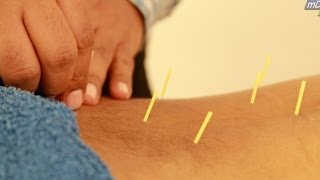 HINDI Acupuncture Treatment Demo [upl. by Orpah]