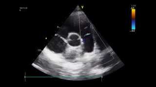 Diastolic flow in the pulmonary artery coronary fistula echo [upl. by Birdt770]