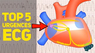 🔴 Le TOP 5 des Urgences à lEcg EXPLIQUÉES CLAIREMENT  ​ [upl. by Sybille]