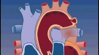 Causes of Aortic Aneurysms [upl. by Pleione]