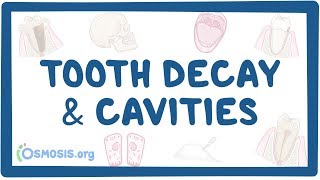 Tooth decay and cavities  causes symptoms diagnosis treatment pathology [upl. by Ailegnave182]