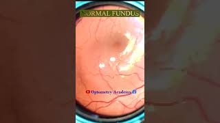 Normal fundus  Normal Retina  Smartphone Fundus Videography  Fundus Photography  Short Video 149 [upl. by Niamor]