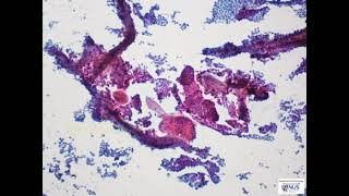 Thyroid cytology  Classical papillary thyroid carcinoma [upl. by Schlesinger]