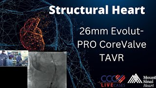 26mm EvolutPRO CoreValve TAVR  March 13 2018 [upl. by Laehcym909]