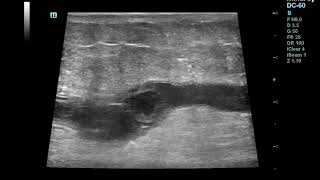 Superficial Thrombophlebitisthrombosis of Great Saphenous Vein [upl. by Xaviera554]