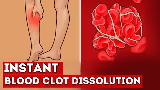 These 7 FOODS Instantly Dissolve Blood Clots in Your Vessels [upl. by Wilde8]