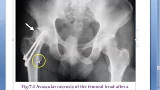 Orthopedics 063 Local Complications of Fracture Part 3 Late Avascular necrosis Sudeck dystrophy [upl. by Adnalor]