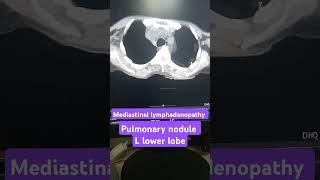 Mediastinal lymphadenopathy on CT scan pulmonary nodule on CT scan [upl. by Illib]