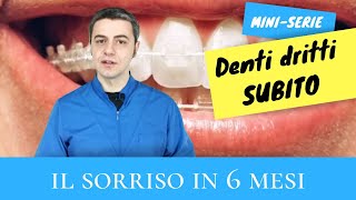 Denti dritti subito  quotIl sorriso in 6 mesiquot [upl. by Pat]