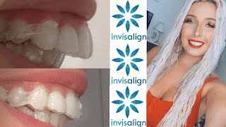 Invisalign Overbite Correction  11 Month UPDATE with before and after pics [upl. by Alleacim]