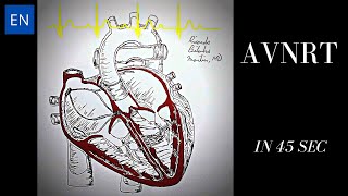 Atrioventricular Nodal Reentry Tachycardia AVNRT Animation and ECG Shorts [upl. by Prendergast]