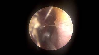 Otitis Media and Myringotomy in the Office Ear drainage of fluid [upl. by Bennie]