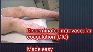 Disseminated intravascular coagulation DIC made easy [upl. by Asiral]