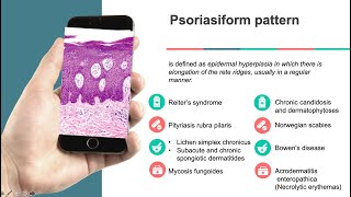 Dermatopathology Psoriasiform reaction pattern [upl. by Luht]