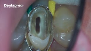 Minimally Invasive Post and Core [upl. by Bogusz18]