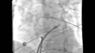 Crossing the septum with NRG™ RF Transseptal Needle [upl. by Stockwell]