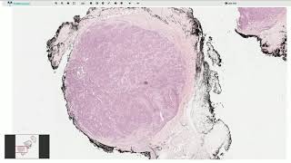 Glomus Tumor  Histopathology [upl. by Kosiur312]