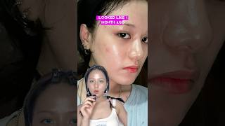 I tried Antioxidant Serum on my ACNE SKIN for 30days⁉️😨 skincareroutine clearskin [upl. by Behn]