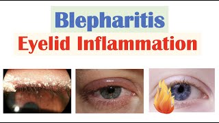 Blepharitis Eyelid Inflammation  Causes Risk Factors Signs amp Symptoms Diagnosis Treatment [upl. by Joselow]