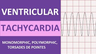 Ventricular Tachycardia Vtach ECG Interpretation Treatment Nursing NCLEX Review [upl. by Oihsoy]