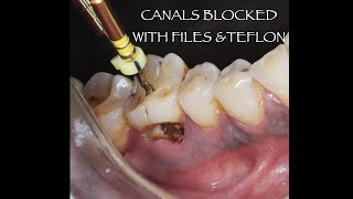 Endodontic management of CLASS V caries in 46 with caries perforating the floor of the pulp chamber [upl. by Haley]