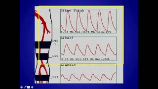 How to Perform and Interpret Peripheral Arterial Doppler Examinations [upl. by Percy]