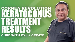 Keratoconus Treatment Results with CREATE Protocol and Crosslinking with Dr Motwani [upl. by Etnohc737]