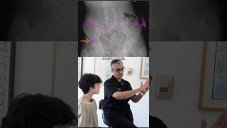 9 Years Limping and SEVERE Back Pain  Coccyx amp Pelvis Adjustment shorts [upl. by Skeie]