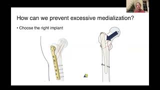 Intertrochanteric and Subtrochanteric Fractures [upl. by Atilal]