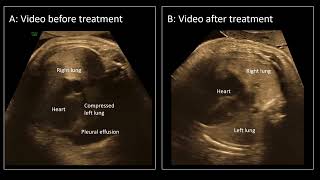 UOGJournal videoclip on the use of maternal propranolol treatment as therapy for fetal chylothorax [upl. by Dorine]