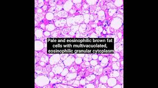 Histopathology of Hibernoma pathology dermpath shorts [upl. by Suvart638]