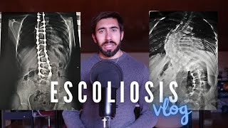 mi experiencia con la operación de escoliosis [upl. by Egni]