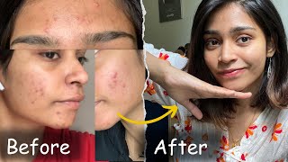 This Changed my life…  No product  No doctor  Acne journey Tamil [upl. by Suk689]