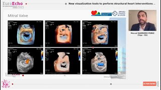 Philips at EuroEcho 2021  Professor Manuel Barreiro [upl. by Tirma]