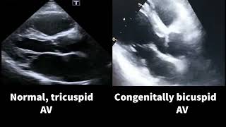 Bicuspid Vs Tricuspid AV [upl. by Eesyak857]