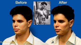 NYC Male Model Makeover by Dr Douglas Steinbrech  Part 5 [upl. by Adlesirhc]