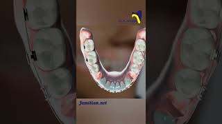 Lower first Premolar Extraction in Class III Malocclusion Correction dentist class3 orthodontics [upl. by Neiman]