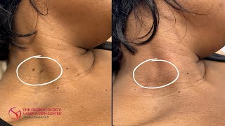 Skin Tag Removal  Dr Shalini Gupta [upl. by Westland82]