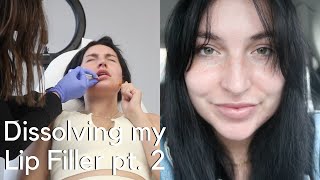 Dissolving Lip Fillers Before and after with hyaluronidase Vlog pt 2 [upl. by Mickey]