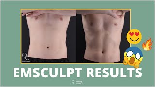 EMSCULPT  Before amp After’s   Is it WORTH it  amp Does it WORK  Quinn Clinics Bristol [upl. by Gillett]