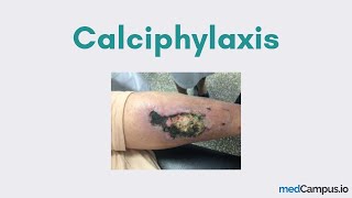 Calciphylaxis CUA [upl. by Eustache410]