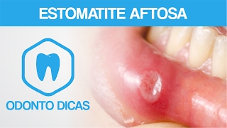 ESTOMATITE AFTOSA  ODONTO DICAS [upl. by Ellinehc]