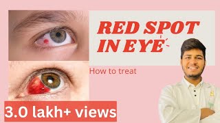 Blood spot in eye reasons How to treat blood spot in eye  Subconjunctival haemorrhage [upl. by Lalat]