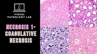NECROSIS part1 COAGULATIVE NECROSIS [upl. by Kylander723]