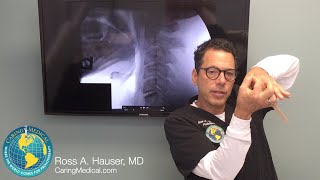 Neck pain after C5C6 disc replacement surgery  DMX review with Ross Hauser MD [upl. by Welcher]